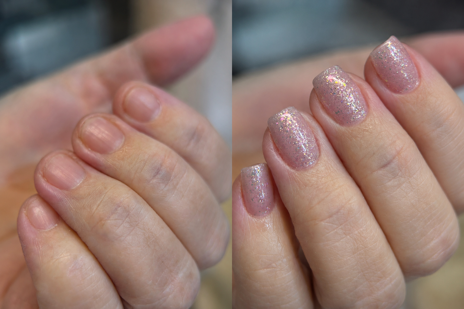 Antes e depois de unha roída